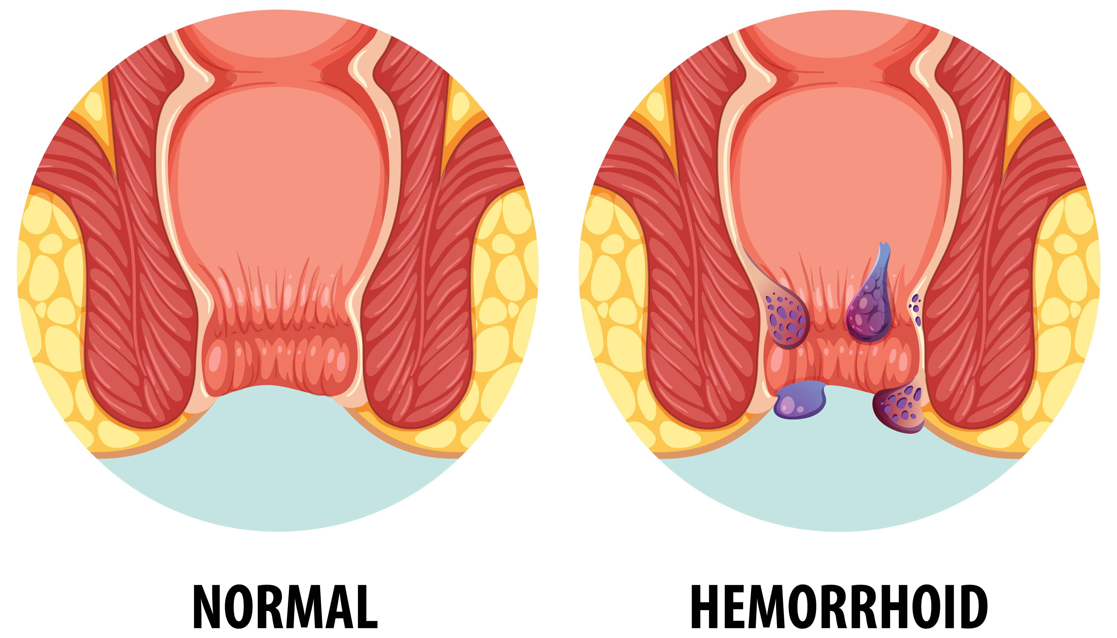 Laser Fissure Treatment in Hanamkonda & Warangal