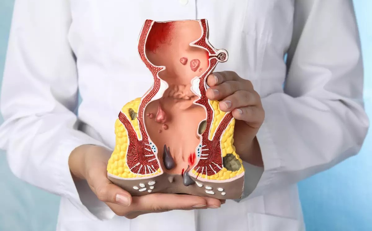 Best Laser Piles Clinic in Warangal