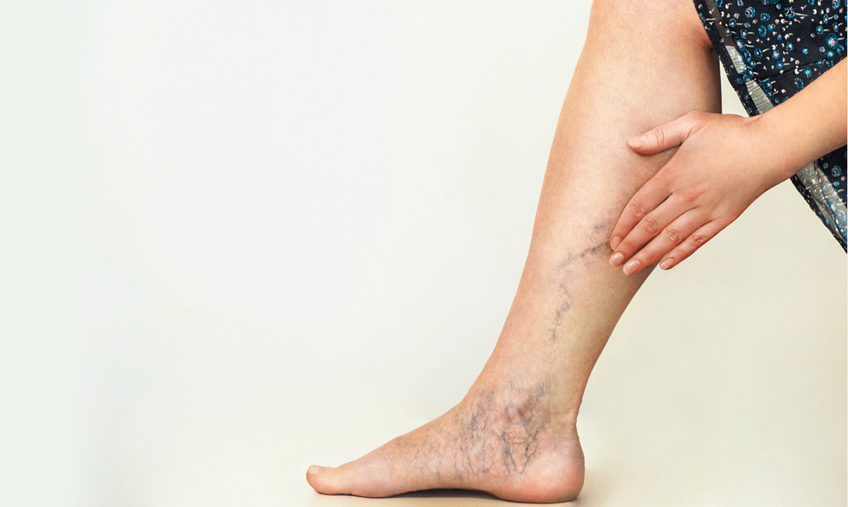 varicose veins hospital in hanamkonda